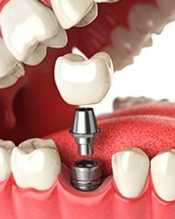 tooth replacement.jpg