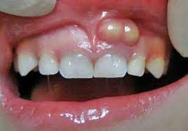 Abcesso dentario.jpeg
