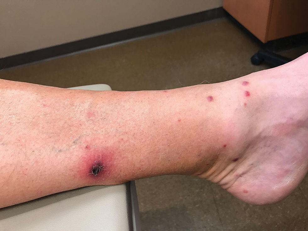 Photo of tick bites