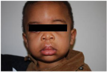 African American baby boy post op
