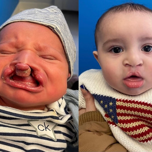 Before and after surgery comparison of baby with cleft and lip palate repair.