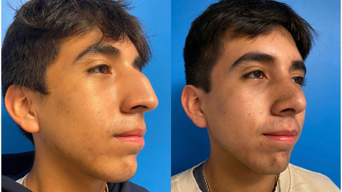 3/4 right view of before and after rhynoplasty on young hispanic male patient