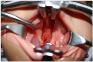 Split cleft palate open for surgery close up image