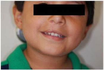 Hispanic baby post op surgery for cleft and lip palate surgery