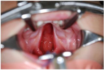 Close up of split palate spread open with medical instruments
