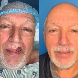 Male with Mohs on lip area, before and after surgery