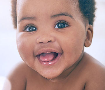 Baby smiling post op cleft lip & palate surgery