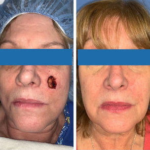 Female with Mohs on left cheek area, before and after surgery
