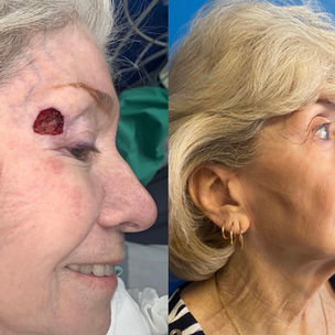 Female with Mohs on eye area, before and after surgery 