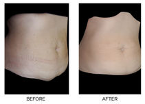 PROTOCOL: Stretch marks correction with Hyalual Perfoskin (video)