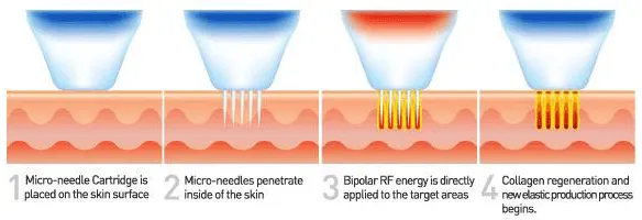 RF MICRONEEDLING ASIA ROSE MED SPA ATLANTA