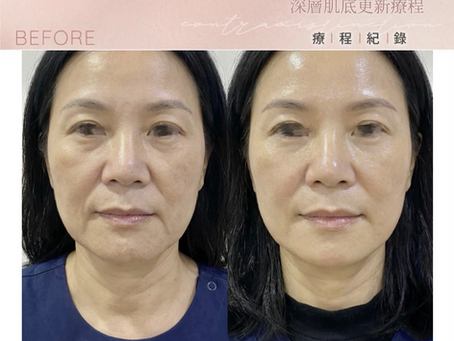 Skin Renewal · New Treatment