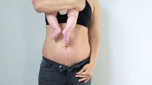 Rozstępy po ciąży – czy da się je całkowicie usunąć