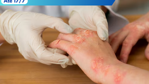 Orientações FórumCCNTs: Consulta Pública - Incorporação no SUS de medicamentos para o tratamento da Dermatite Atópica em adultos - Até 17/7