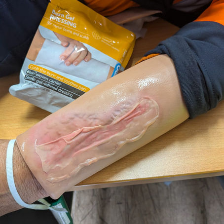 The 20-Minute Rule: Why Correct Burn First Aid is Critical in Central West NSW