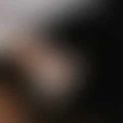 Why Are Allergies and Anaphylaxis Becoming More Prevalent?