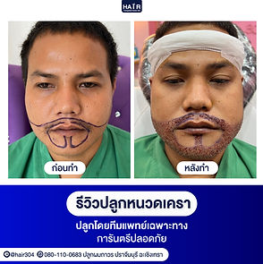 รีวิวปลูกหนวดหล่อเข้ม