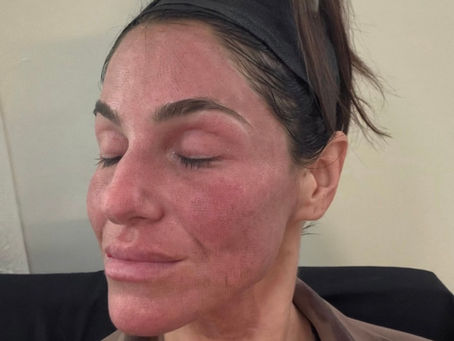 CO2RE Laser Resurfacing