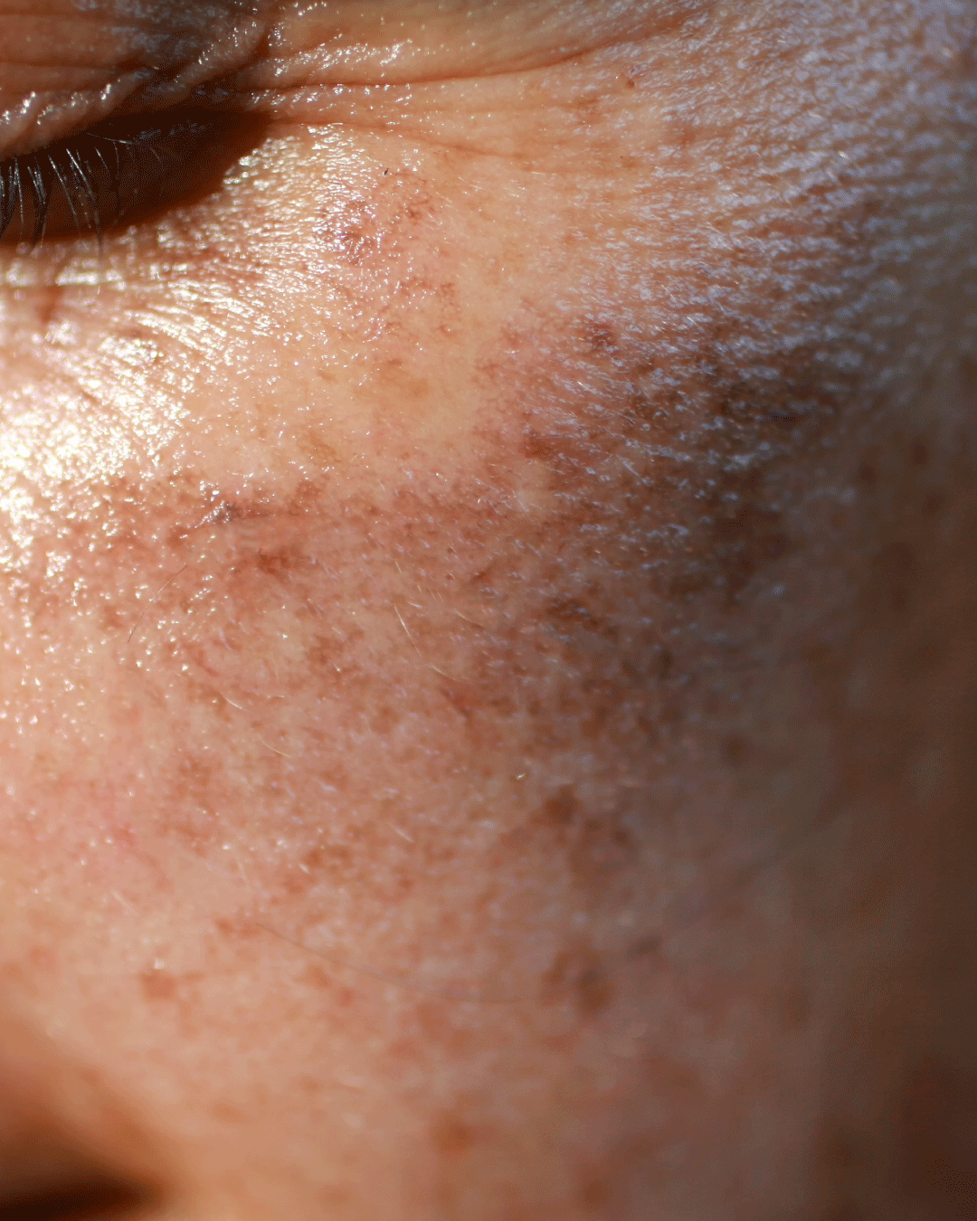 Dermapen Treatment Pigmentation
