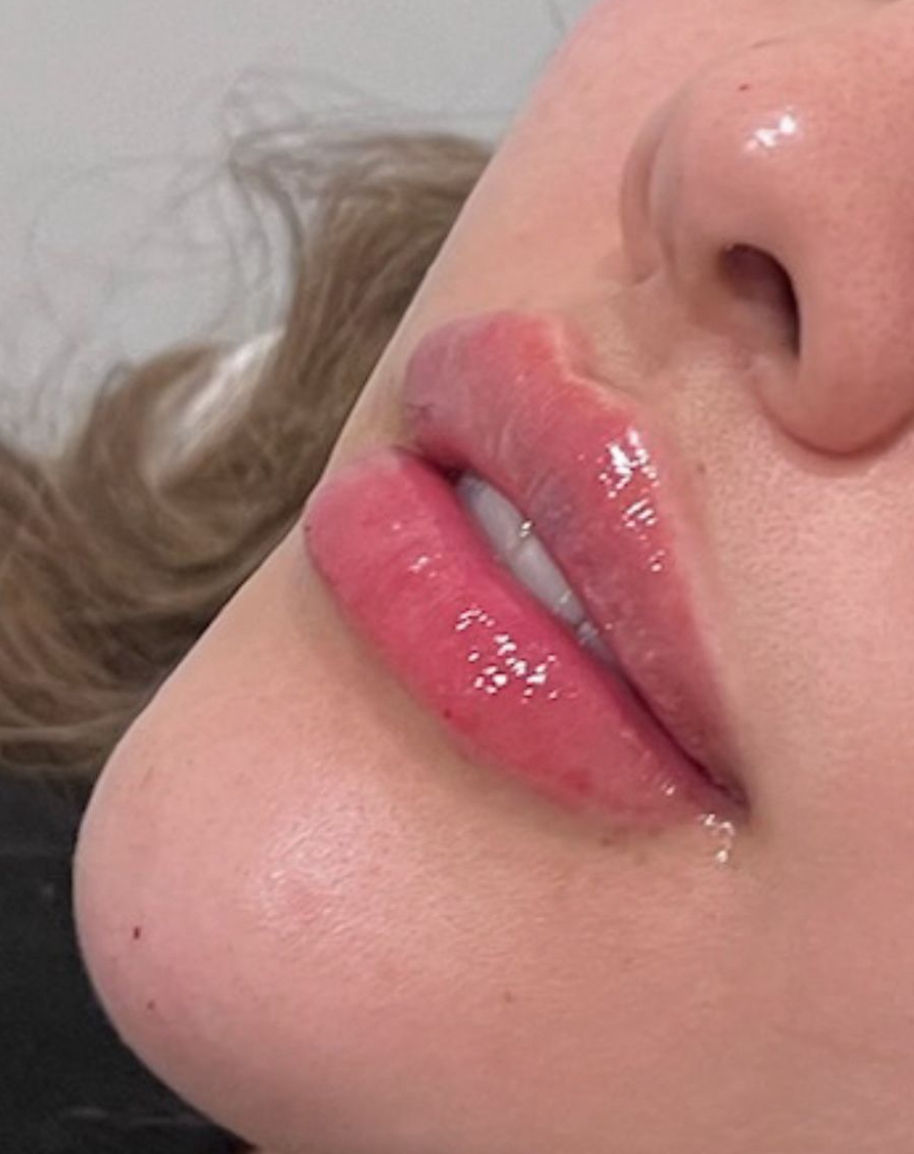 cost of lip filler Vancouver