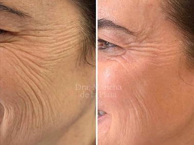 Neo Elite® - NeoSkin® - Skin Rejuvenation (5).png