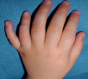 polidactilia-postaxial-icatMA_edited.png