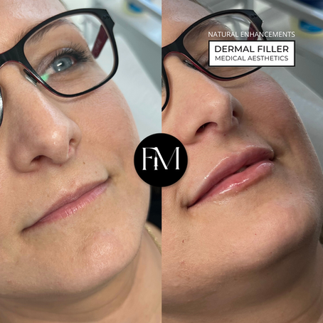 Achieve Natural Enhancements with Dermal Fillers at Faces Medical Aesthetics in Warwick