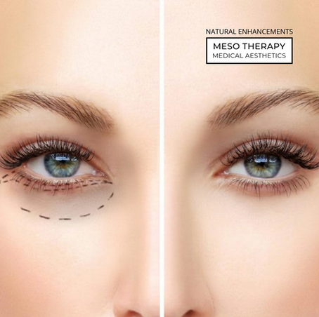 Lumieyes Treatment: A Revolutionary Alternative to Tear Trough Fillers