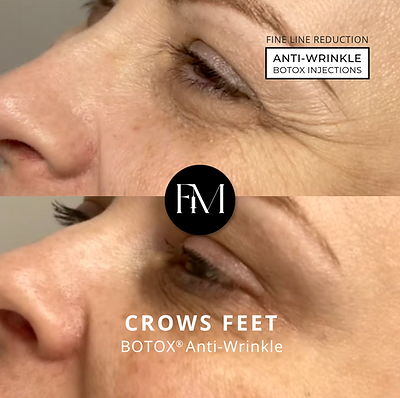 Faces Medical Crows Feet.png