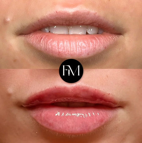 Understanding the Difference Between the Botox Lip Flip and Dermal Fillers for Lips