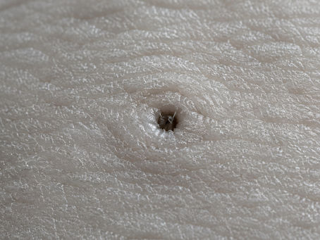 Macro d'un pore cutané — CBD et acné : action sur les sébocytes et les glandes sébacées