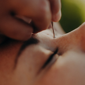 Main insérant une aiguille de réflexologie faciale près de l'œil d'une personne.