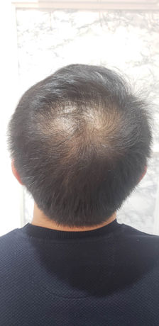 Avant une tricopigmentation à Paris chez Bioty