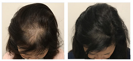 Hairneedling après chute de cheveux par Sabia, experte à Paris
