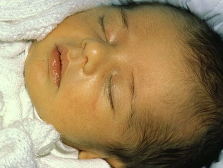 newborn jaundice