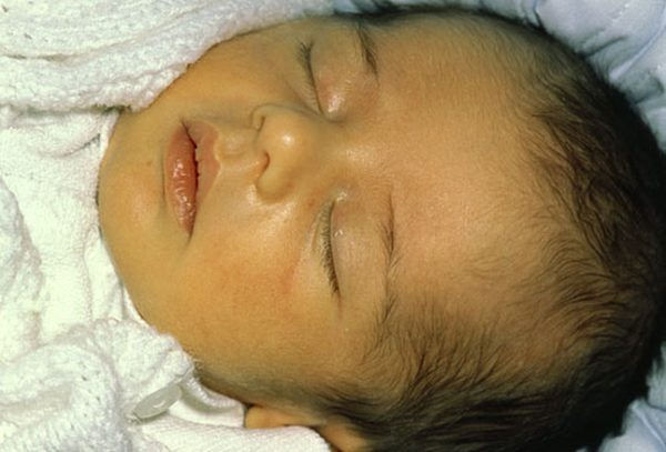 newborn jaundice