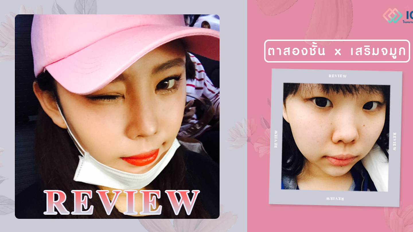 รีวิวเสริมจมูกทรงบาร์บี้ไลน์ และทำตาสองชั้น (ตอนที่ 1)