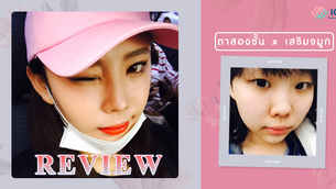 รีวิวเสริมจมูกทรงบาร์บี้ไลน์ และทำตาสองชั้น