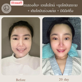รีวิวศัลยกรรมเกาหลี โรงพยาบาลศัลยกรรมลีอาย (Li eye Plastic Surgery)