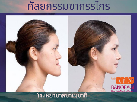 รีวิวศัลยกรรมขากรรไกร โรงพยาบาลบาโนบากิ