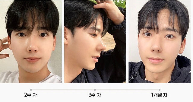 รีวิวศัลยกรรมผู้ชาย > โรงพยาบาลอิพิก (Epic Plastic Surgery)