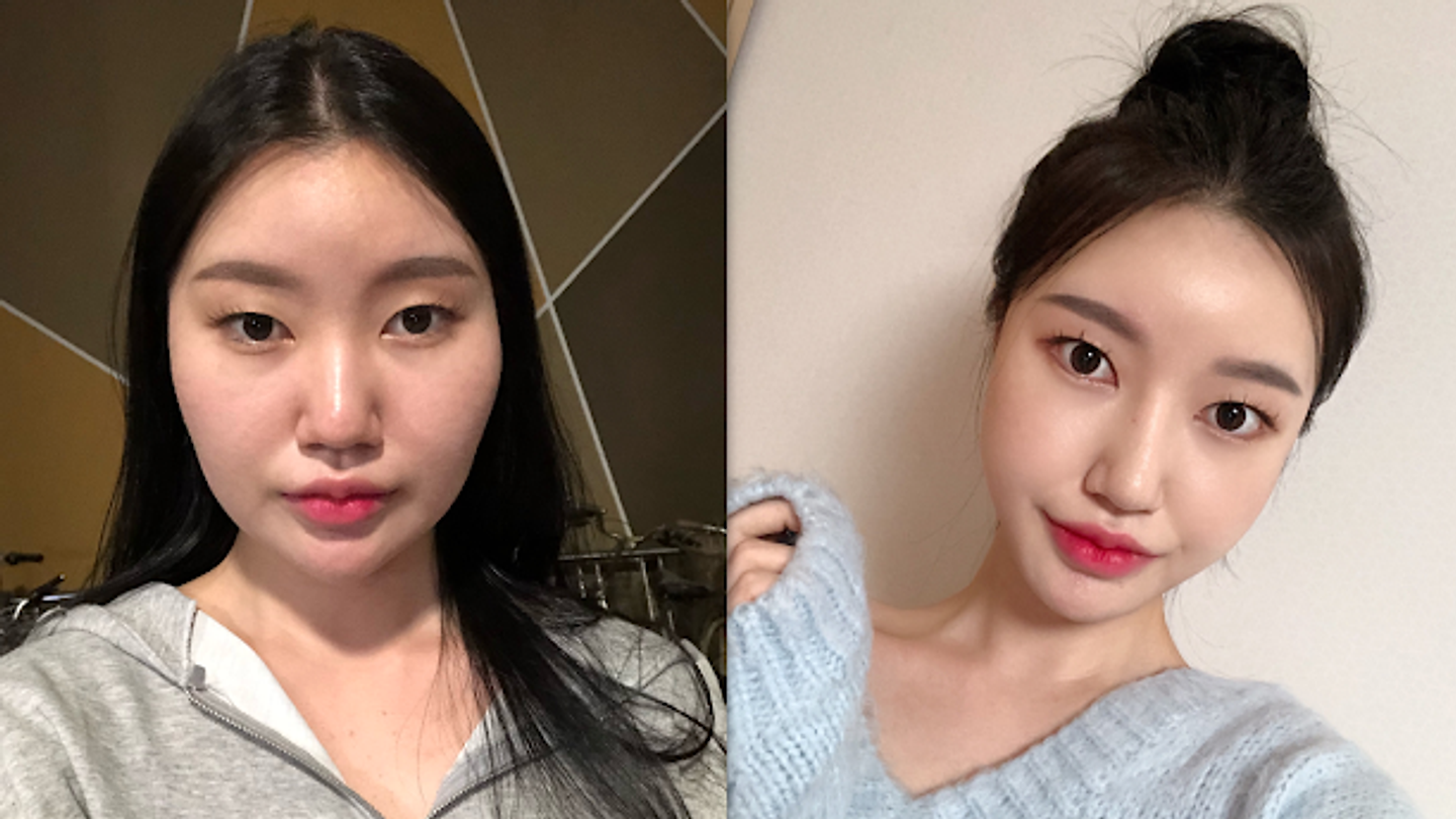 ศัลยกรรมโครงหน้า 3 จุด + เสริมจมูก ผ่าใหญ่ครั้งเดียวสวยเลิศกลับมาเลย (ตอนที่ 2)