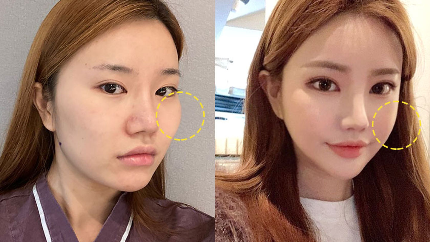 ลดขนาดโหนกแก้มที่เอบี จบปัญหาโหนกแก้มนูน หน้าบาน หน้าแบน