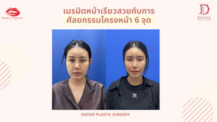 เนรมิตหน้าเรียวสวยกับการศัลยกรรมโครงหน้า 6 จุด