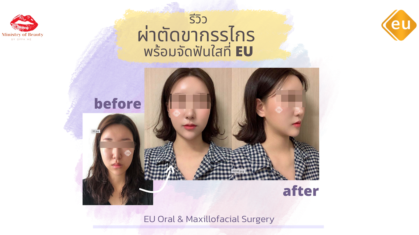 รีวิวผ่าตัดขากรรไกร พร้อมจัดฟันใสที่ EU (ตอนที่ 2)
