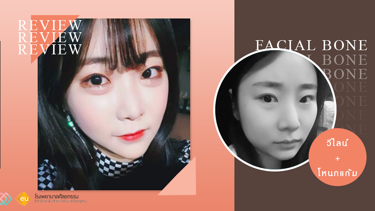 รีวิวปรับรูปหน้า วีไลน์ และลดโหนกแก้ม (ตอนที่ 2)