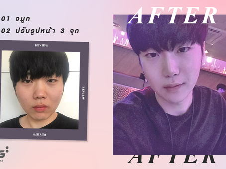 รีวิวศัลยกรรมปรับรูปหน้า และเสริมจมูก แก้ปัญหาจมูกสั้น