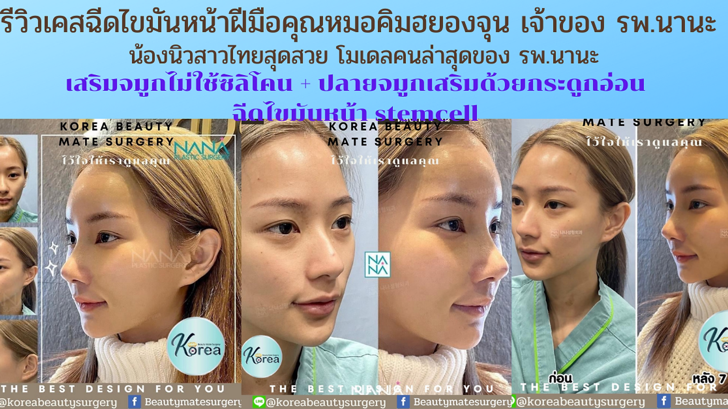 รีวิวศัลยกรรมฉีดไขมันหน้า Stemcell (ตอนที่ 2)