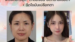 รีวิวศัลยกรรม โครงหน้า3จุด+ ตาสองชั้น มัดกล้ามเนื้อตา + ฉีดไขมันเปลือกตา