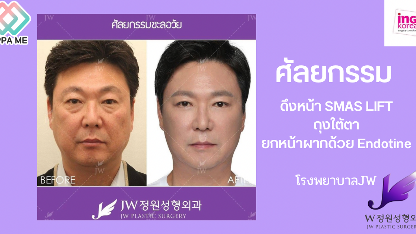 ศัลยกรรมถุงใต้ตาแบบกรีดตัดผิวหนังหย่อนคล้อยและถุงไขมันส่วนเกิน+ศัลยกรรมดึงหน้า SMAS Lift (Full Face) (ตอนที่ 2)